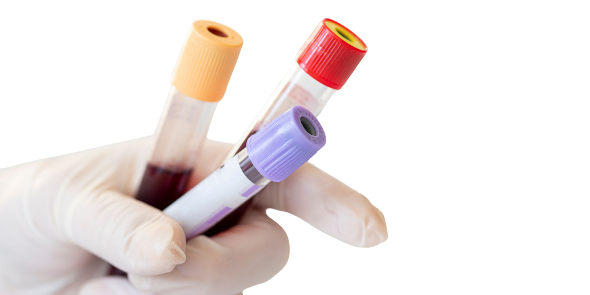 Jaarlijks Bloedonderzoek: Wat wordt Gecontroleerd en wordt het vergoed