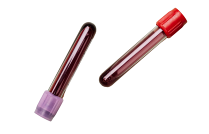 Hematocriet te hoog: Oorzaken, gevolgen en oplossingen