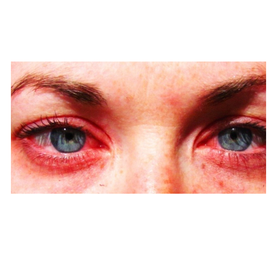 Expat Health Clinic | Basic Allergy Panel