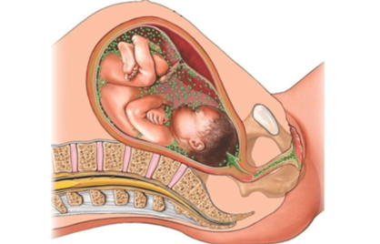 Groep B Streptokokken (GBS) en zwangerschap: hoe werkt het in Nederland en in andere landen?
