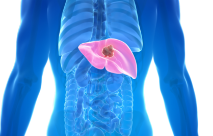 Heb ik erfelijke hemochromatose? Zo ontdek je of je teveel ijzer stapelt