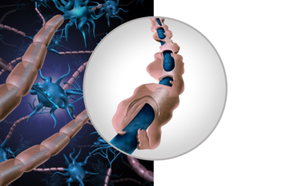 Multiple sclerose (MS) en leefstijl: hoe biomarkers inzicht geven