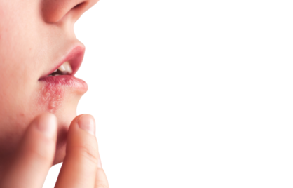 Wat betekent een positieve herpes-uitslag in je bloed? En wat is het verschil tussen HSV-1 en HSV-2?