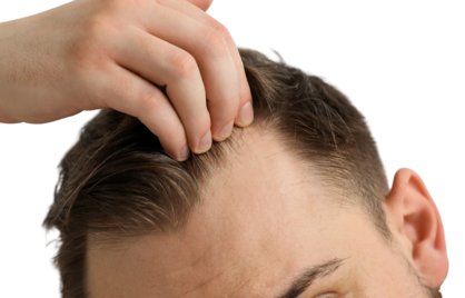 Waarom worden mannen kaal? De waarheid over DHT, hoofdhuidspanning, vitamines en hormonen