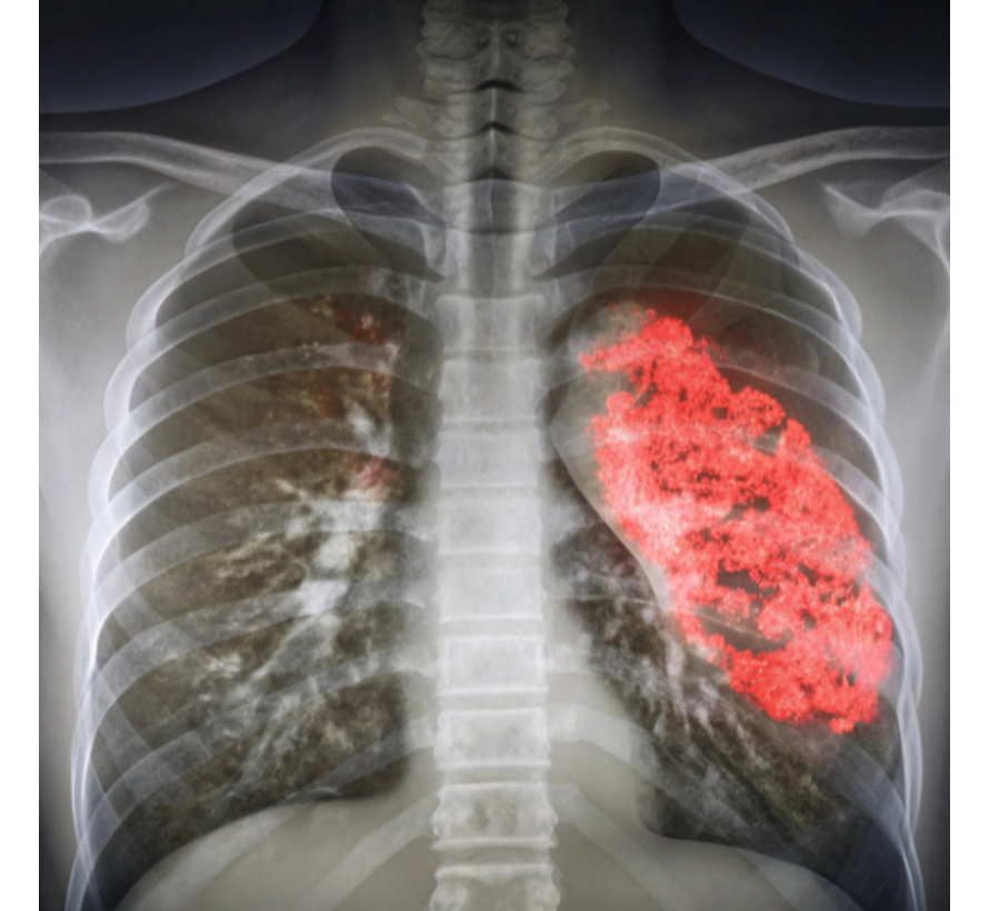 Mycoplasma pneumoniae bacterie longontsteking
