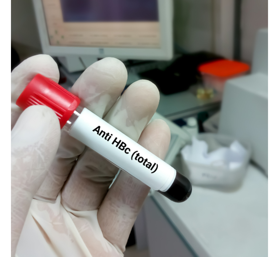 Hepatitis anti-HBc-IgM