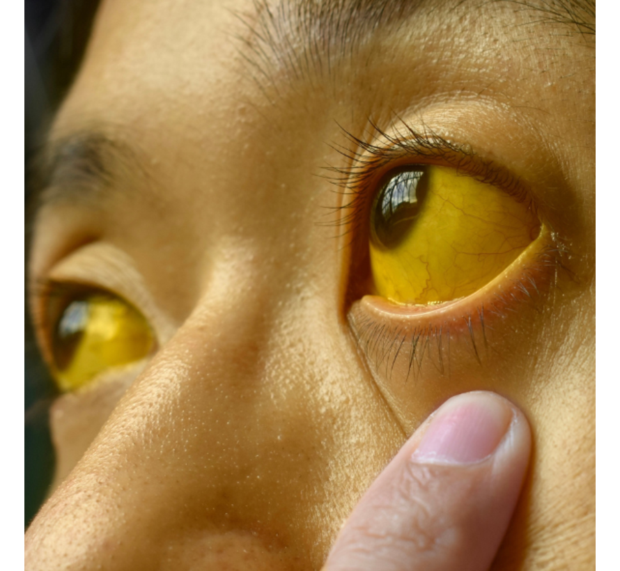 Antilichamen tegen Autoimmuunhepatitis (leverantigeen) blottest