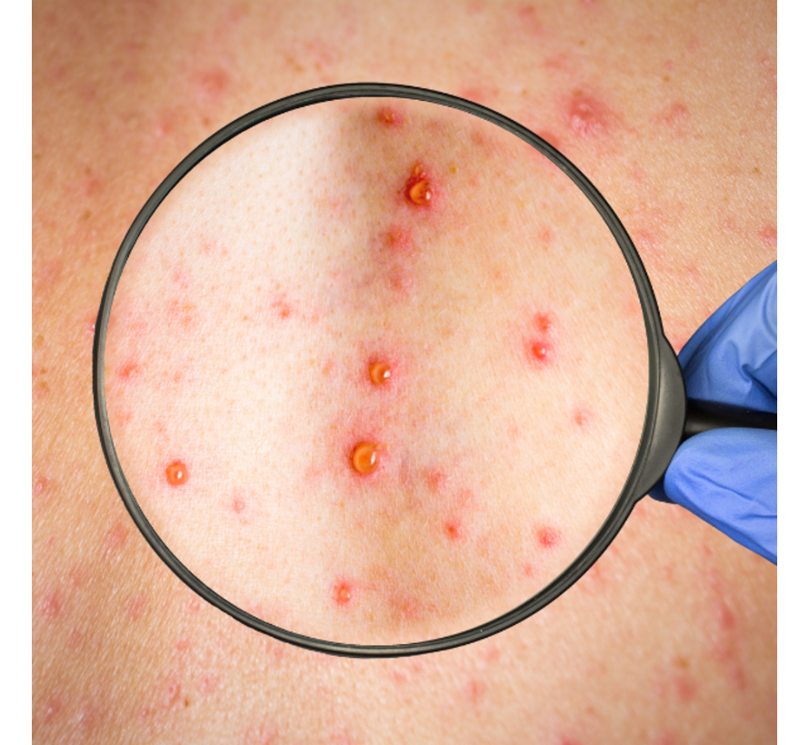 Ben ik nu besmet met Rubella Rode Hond ?