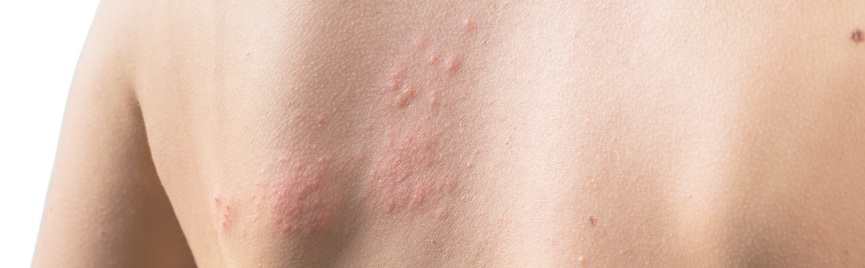 Histamine-intolerantie: de vergeten trigger achter uiteenlopende klachten