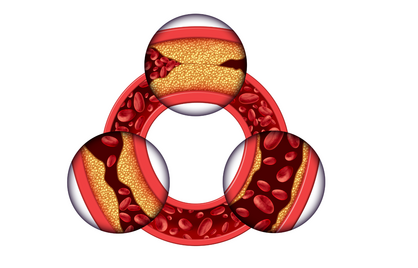 5 verrassende factoren die je cholesterol beïnvloeden (en waarom het niet alleen om LDL draait)