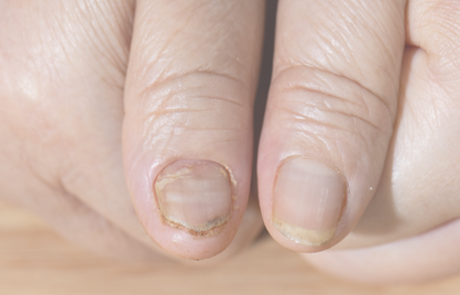 Broze nagels door een tekort? Dit zeggen je bloedwaarden