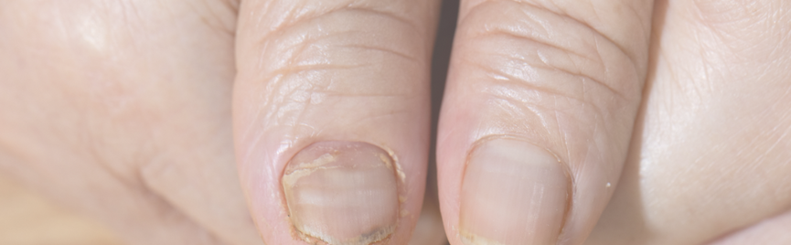 Broze nagels door een tekort? Dit zeggen je bloedwaarden