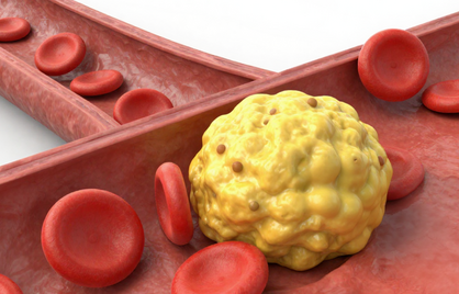 Wanneer is je cholesterol te hoog?