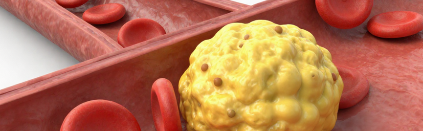 Wanneer is je cholesterol te hoog?
