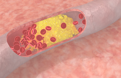 Lipoproteïne(a) en ApoB: wat LDL en HDL niet vertellen