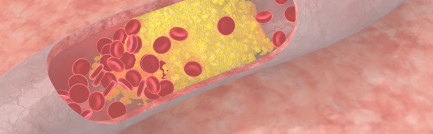 Lipoproteïne(a) en ApoB: wat LDL en HDL niet vertellen