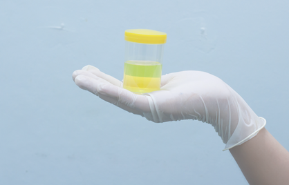 Leukocyten in urine zonder pijn: wat kan dat betekenen?