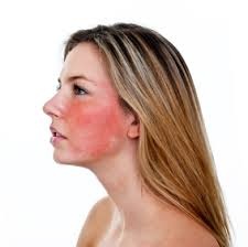 Histamine intolerantie, rode wangen