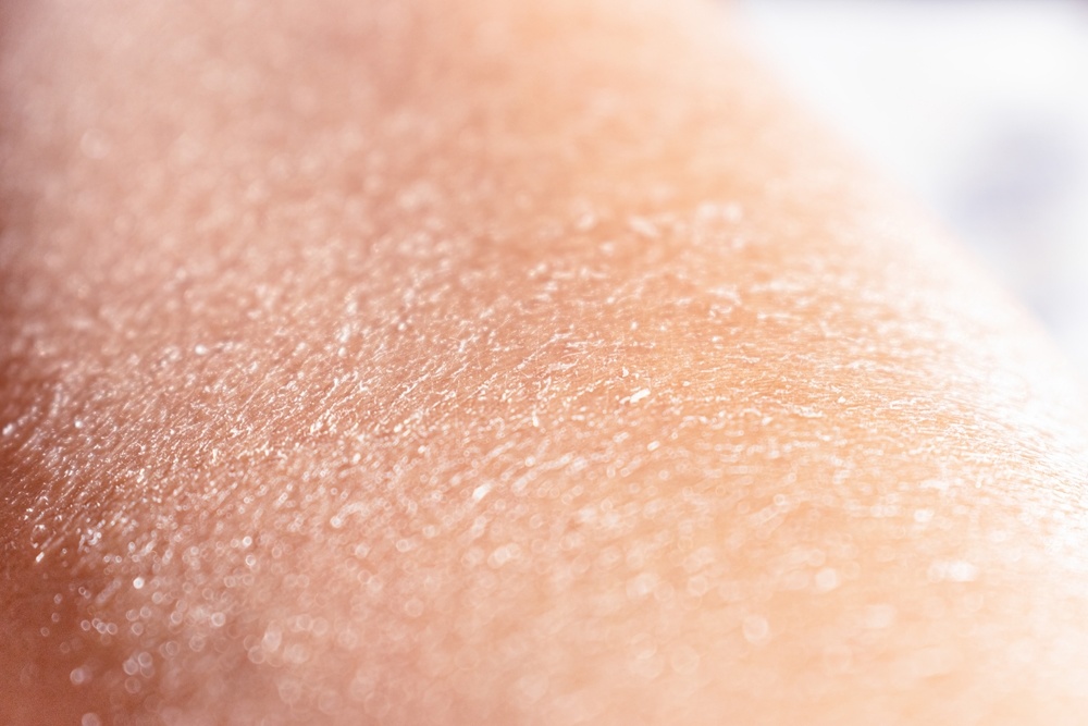 Schilferige Huid Symptomen Oorzaken En Oplossingen Dermatologie Schilferige Huid Symptomen Oorzaken En Oplossingen Dermatologie
