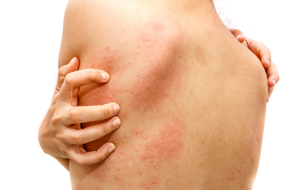 Huidirritatie of allergie: uitleg & tips!