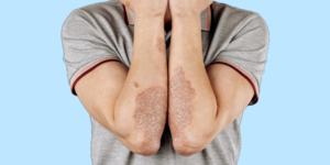 Soorten en symptomen van psoriasis