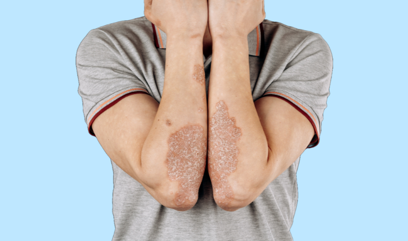 Psoriasis: Herken de vormen en de symptomen