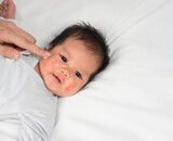 Eczeem in het gezicht van baby's: symptomen, behandeling en tips