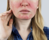 Plotseling heb ik een rood en warm gezicht: Is het rosacea?