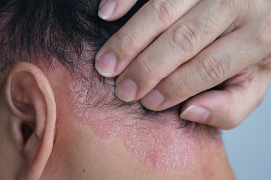 psoriasis hoofdhuid