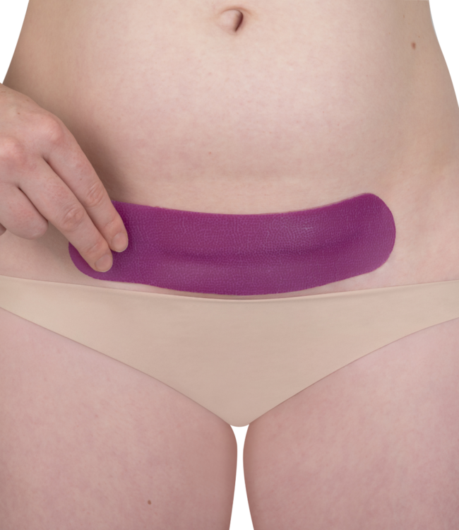 Scarban C-Section litteken siliconenpleister