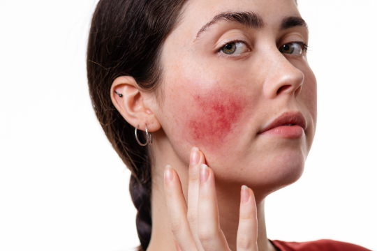 Rosacea behandelen