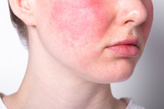 Wat is rosacea