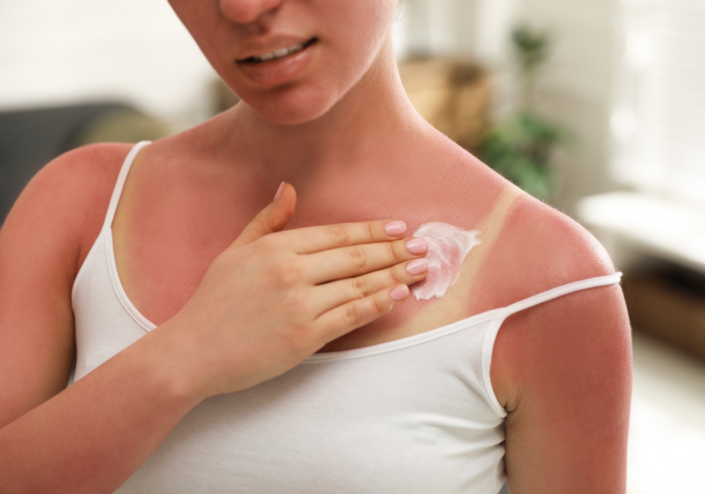 Verbrand door de zon: wat te doen?