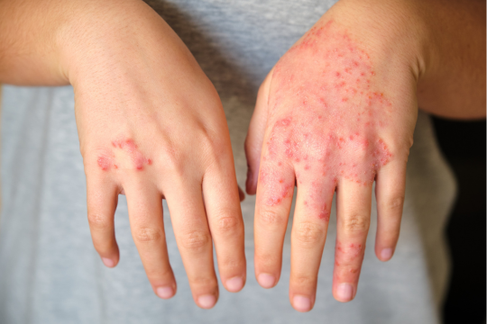 atopic eczema