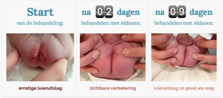 luieruitslag behandeld in ziekenhuis