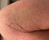 Wat is TSW (Topical Steroid Withdrawal)?