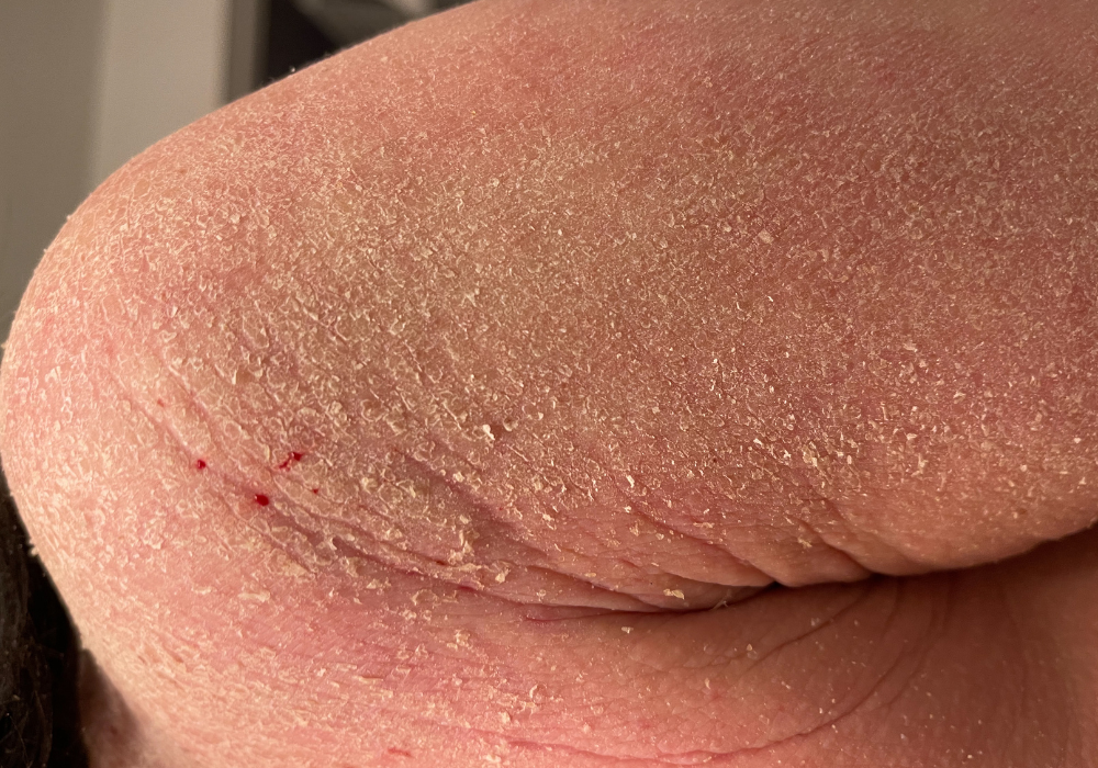 Wat is TSW (Topical Steroid Withdrawal)?