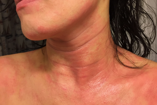 topical steroid withdrawal