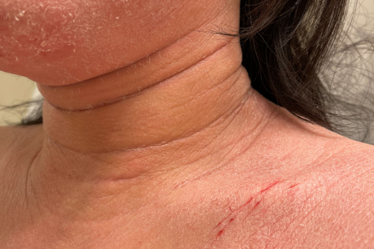 topical steroid withdrawal