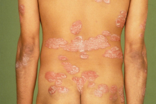 Psoriasis vulgaris