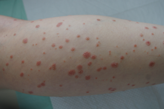 Psoriasis guttate
