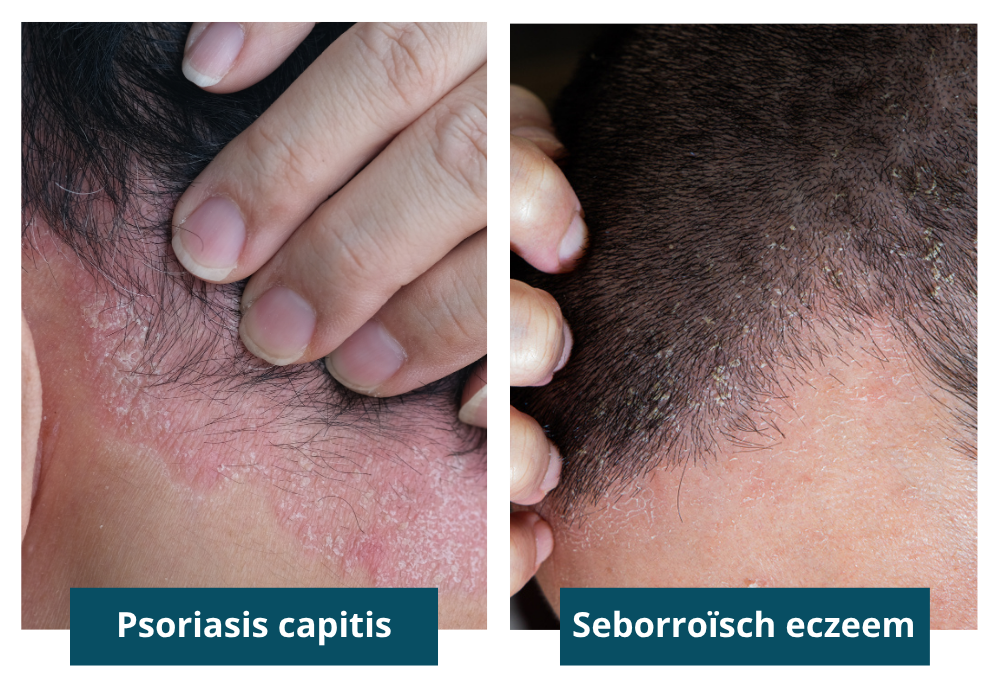 Verschil psoriasis capitis en seborroïsch eczeem