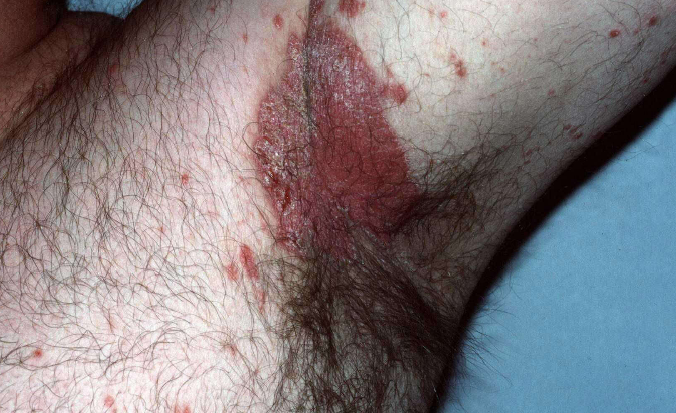 Psoriasis inversa