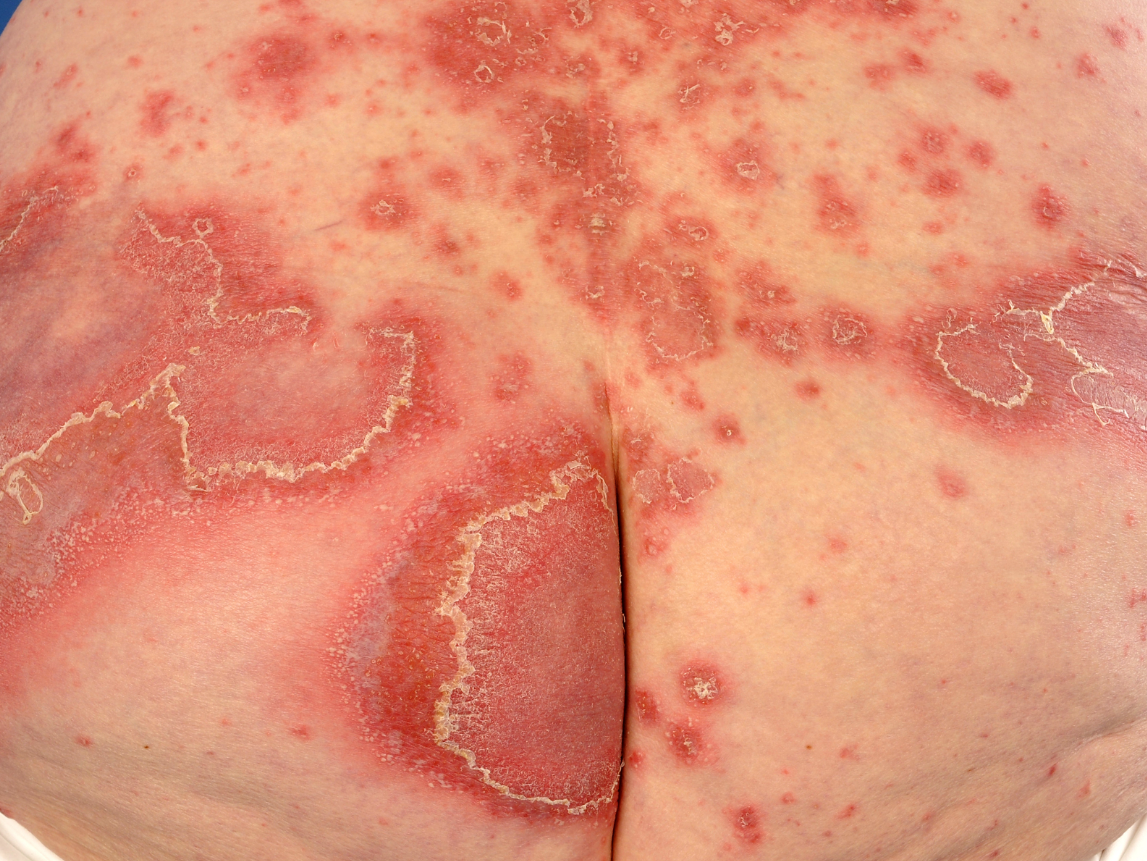 Psoriasis pustulosa