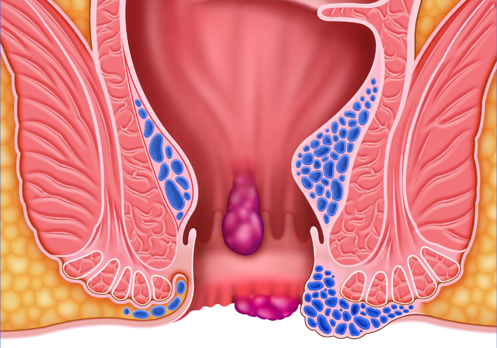 uitwendige en inwendige aambeien