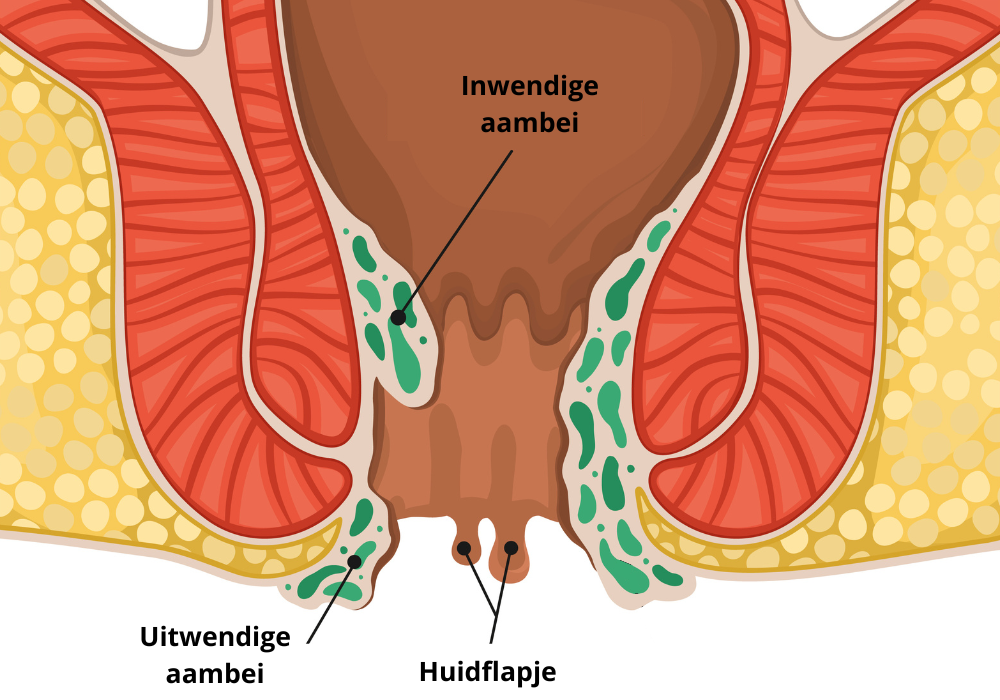 uitwendige en inwendige aambeien