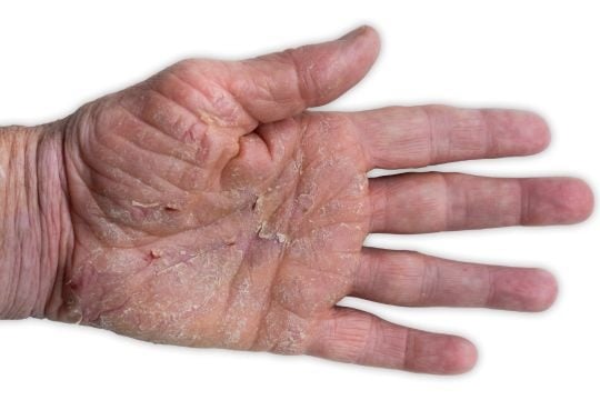 hand eczeem met schilfers, kloofjes en rode plekken