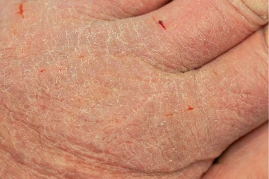 hand extreem droge huid met kloofjes, schilfers en rode plekken
