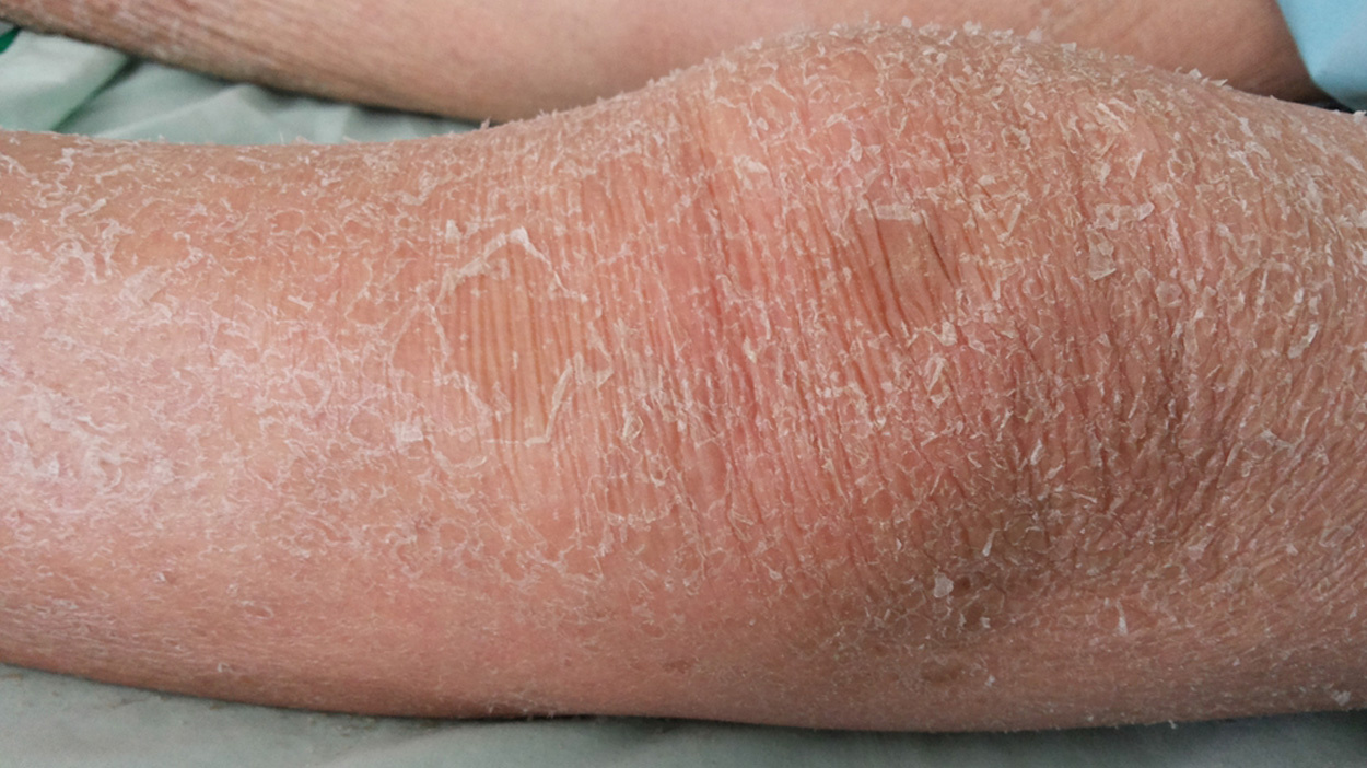 extreem droge huid op benen schilfers