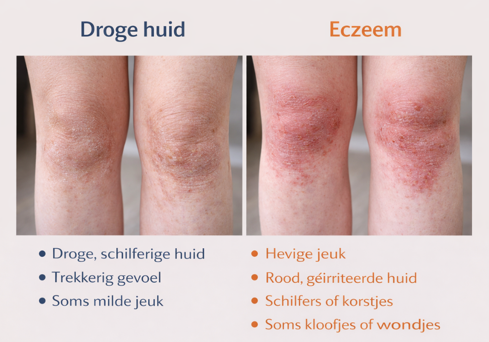 verschil droge huid en eczeem op de benen